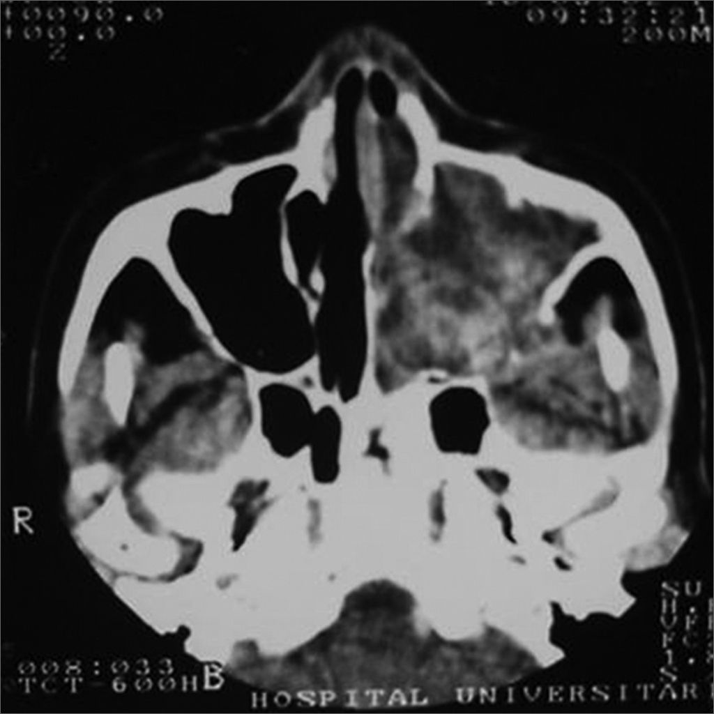 Sublabially Inflammatory pseudotumors of the paranasal sinuses | Brazilian Journal ...