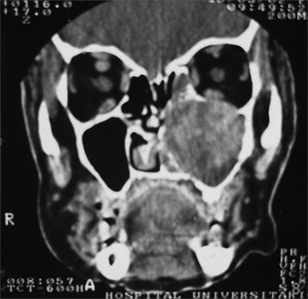 Sublabially Inflammatory pseudotumors of the paranasal sinuses | Brazilian Journal ...