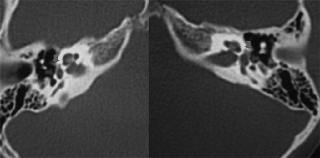 Pediatric otosclerosis: Case report and literature review | Brazilian ...