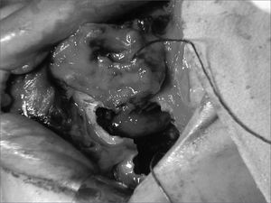 Middle-face degloving with anterior maxillary sinusotomy, showing stesioneuroblastoma (case 1).