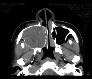 CT scan - axial cross section of a GCCG (case 2).