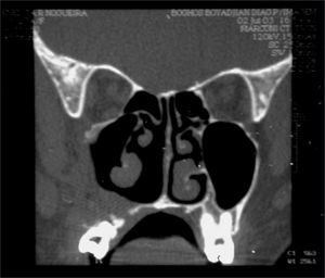 CT scan - coronal view of a GCCG post operative (case 2).