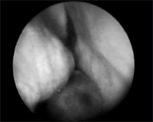 RNC Extramedullary Plasmocytoma - nasal fibroscopic view. (case 3).