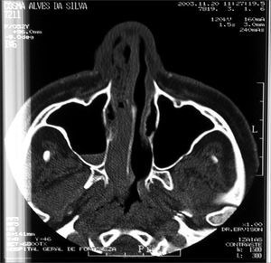 CT scan - axial view of Extramedullary Plasmocytoma (case 3).