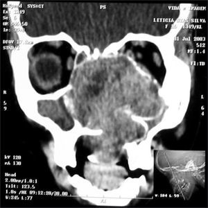 CT scan - coronal view of a nasosinusal hemangiopericytoma (case 4).