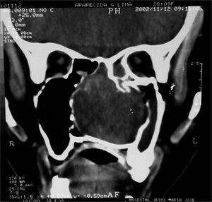 CT scan - coronal view of a neurofibroma (case 5).