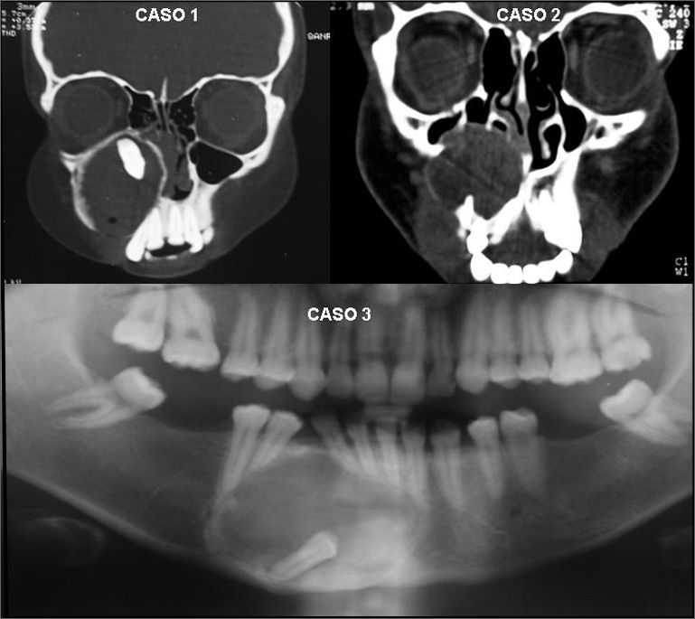 Aot Radiograph Adenomatoid Odontogenic Tumor Radiography Follicular Adenomatoid