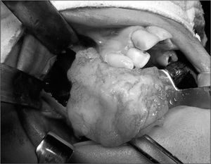 Transoperative view showing bone resection to remove a maxillary odontogenic myxoma.