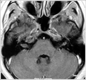 MRI (T1 contrast-enhanced) case 2 preoperative axial view.
