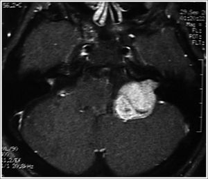 MRI (T1 contrast-enhanced) case 3 preoperative axial view.