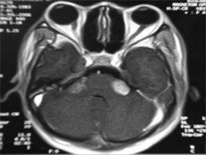 MRI (T1 contrast-enhanced) case 4 preoperative axial view.