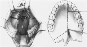 Representation of a hard and soft palate incision / maxillary division and placement of retractors.