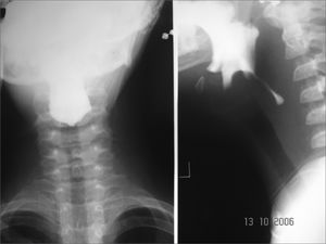 Esophageal stenosis in the cricoid constriction