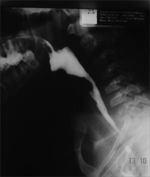 Patient in the previous figure after dilatation with metal olives