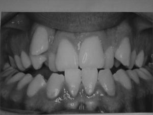Frontal view of dental occlusion in a patient with maxillary atresia. Note the presence of bilateral posterior crossbite and anterior dental crowding.