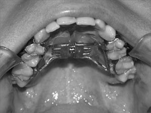 Cemented Hyrax-type expander apparatus (tooth-borne) on teeth before the maxillary expansion procedure.