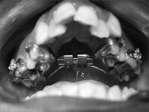 Cemented Haas-type expander (tooth tissue-borne) on teeth before the maxillary expansion procedure.