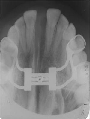 Occlusal radiograph of the maxilla after the maxillary expansion procedure. Note the opening of the midpalatal suture.