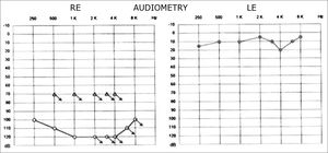 Pure tone audiometry before therapy.
