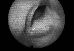 Laryngoscopy showing smooth-surface tumor involving the entire left vocal fold.