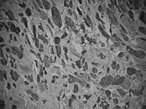Immunohistochemical expression of protein S100-positive tumor cells.