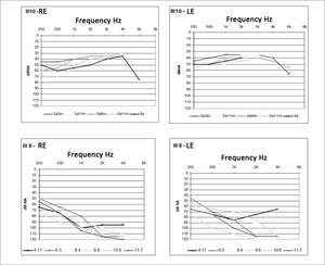 Hearing loss progression of subjects III-8 and III-10 - Colored legends indicate subject age at the time of the examination.