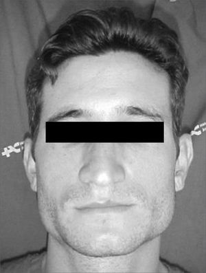 Patient with bilateral masseter muscle hypertrophy.