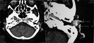 Adenoid Cystic Carcinoma in Left External Ear Canal - Axial view CT scans of temporal bones (with and without contrast enhancement)