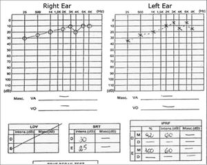 Pure tone and voice audiometries of the patient prior to therapy.