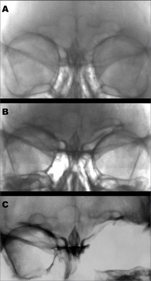 Images of the victim’s frontal sinus in 1989(A), 1993(B), and post-mortem in 2006(C).