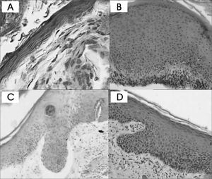 Cholesteatoma fragments: A- Atrophy (HE - 400x) B- Acanthosis (HE - 100x) C and D- Formation of epithelial cones (HE - 100x)