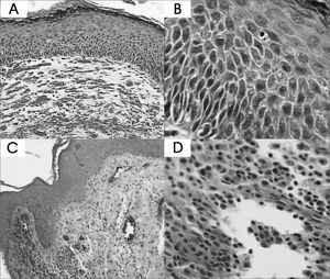 Cholesteatoma fragments: A and B- Basal layer hyperplasia (HE - 100x and 400x) C e D- Perimatrix inflammatory process (HE - 100x and 400x).