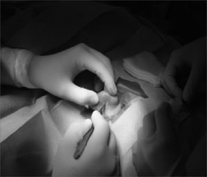 Intraoperative