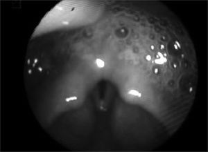 Saliva stasis - Swallowing videoendoscopy exam, showing the presence of saliva stasis in the pyriform recesses, in the retrocricoid area and signs of aspiration.
