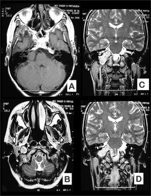 Preoperative MRI images (A and B - axial views, and C and D - coronal views) showing lesion location and size.