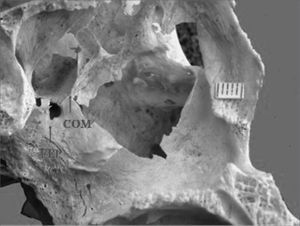 Single sphenopalatine foramen located in the middle nasal meatus in the left osseous wall of the nasal cavity. Key: COM - bony crest on the middle nasal turbinate, FEP - sphenopalatine foramen.