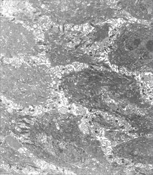 Epithelial surface of a laryngeal granuloma; widening of cell junctions, changing the structure of desmosomes (transmission electron microscope, 1 550 X).