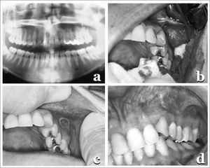 (a) Panoramic X-ray showing a radiolucent, unilocular area, well outlined, in the region of the canine to the first molar in the right side, involving the unerupted tooth; (b) Surgical cavity with the cyst, the ruptured capsule, showing a whitish keratin cluster; (c) fistula; (d) Final clinical case with a normal mucosa.