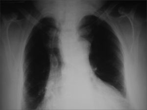Chest X-ray showing deviated trachea and enlarged upper mediastinum due to substernal goiter.