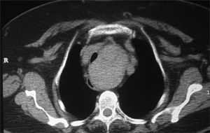 CT scan showing goiter displacing mediastinal structures.