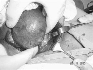 two-finger palpation with dislocation of the substernal goiter lobe.