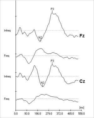 Records of the N2 and P3 components from the P300 Long Latency Evoked Auditory Potential, simultaneously captured by the electrodes positioned on Fz and Cz. Markings of the N2 negative and P3 positive peaks.
