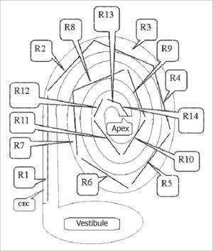 Schematic drawing showing how 3D magnetic resonance imaging measurements were done. R=measurement between two points in the spiral canal of cochlea (CEC). Measurements were done from the vestibule towards the apex of the cochlea, using 2 mm predefined measures for the first six measurements (R1, R2,……, R6) and predefined 2 mm, 1.5 mm or 1.0 mm measures for measurements from R6 to Rx (R14).