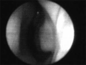 Nasal valve photo after using topical nasal vasoconstriction agent on the erectile tissue of the nasal cavity floor, the nasal septum cavernous body and the head of the inferior turbinate.