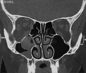 Oncocytic papilloma. Coronal CT showing an opacified right maxillary sinus.