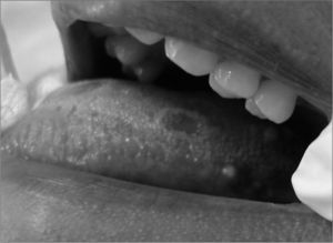 Photography showing erythematous lesions with a discrete white snaky border. A yellow papule is seen on the posterolateral surface of the tongue.