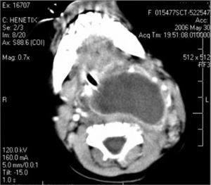 Large retropharyngeal abscess seen in computed tomography (CT).