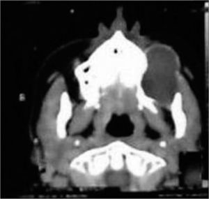 Computed tomography showing an intraosseous cyst in the left maxilla.