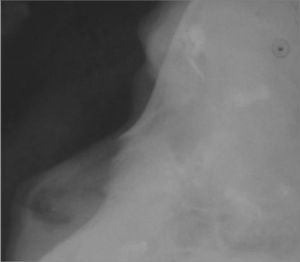 Left side lateral radiograph of the nose in the preoperative