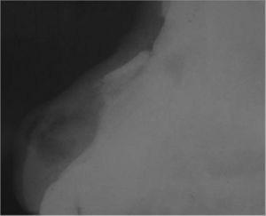 Lateral nose radiograph - immediate postoperative.
